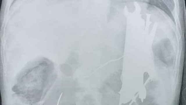 Извадиха гаечен ключ, отвертка, пирони и лъжици от тялото мъж (СНИМКИ)